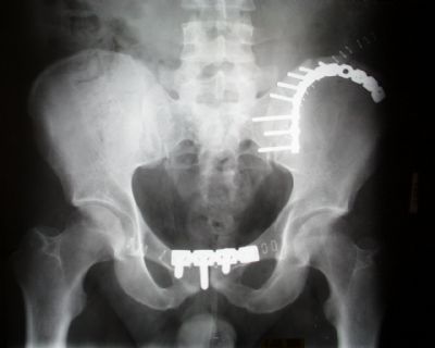 Pelvis:  Synthes Recon Plate (Implant 292)